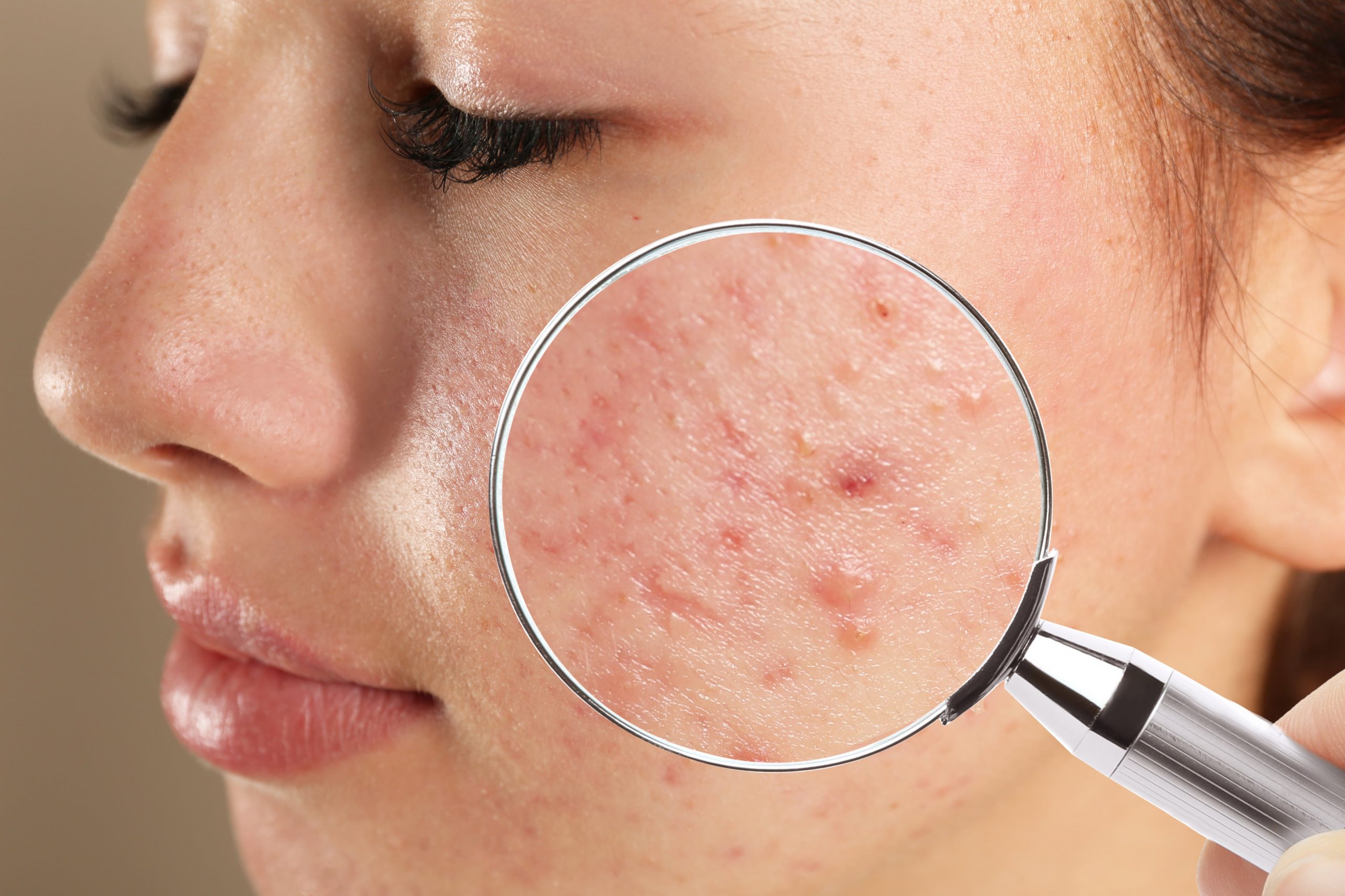 FACTS THAT MAKE YOU REALIZE CBD IS AMONG THE BEST AID TO TREAT ACNE-min