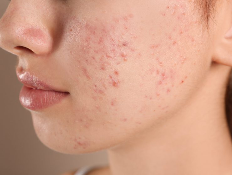 FOODS THAT CAN CAUSE ACNE-min