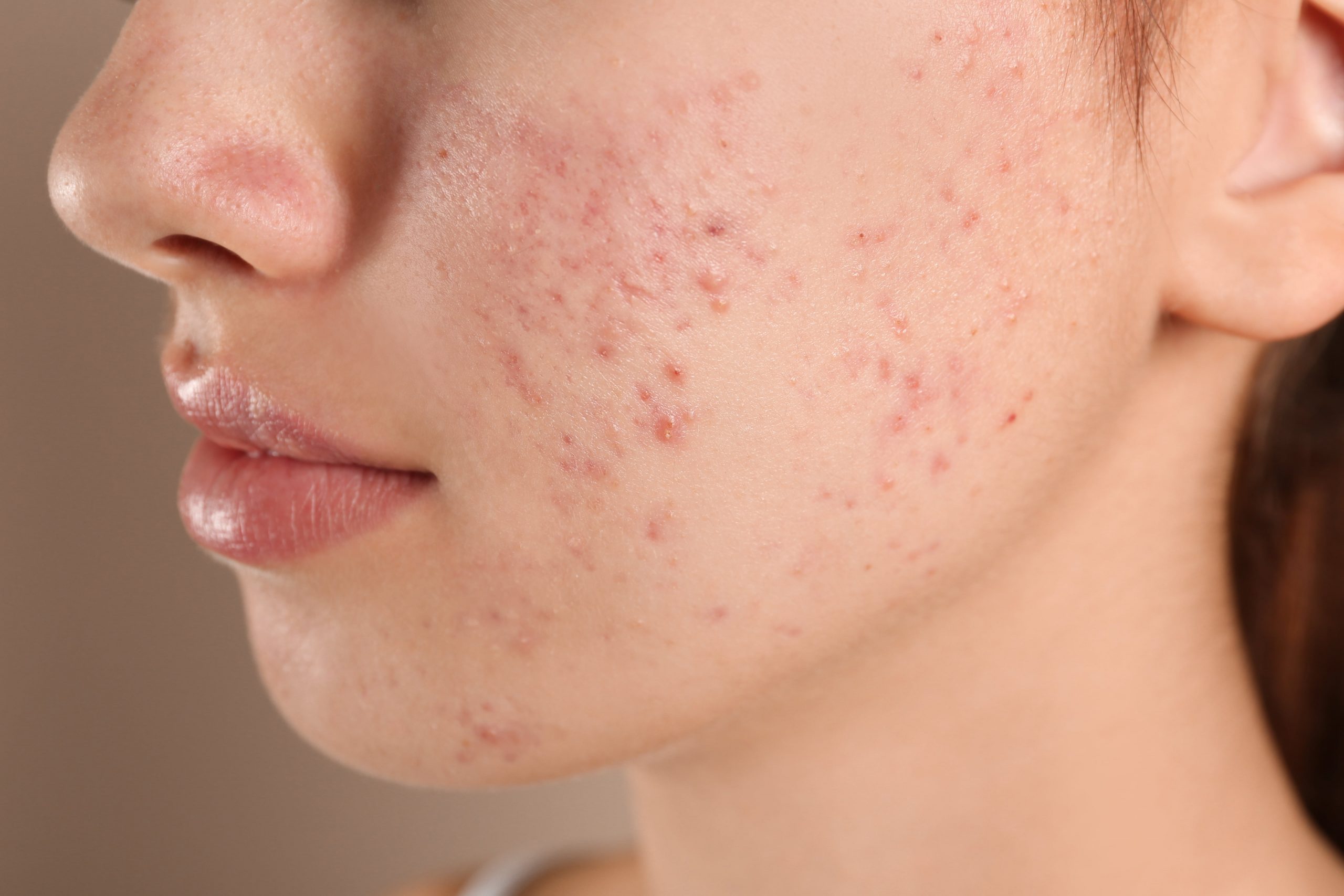 FOODS THAT CAN CAUSE ACNE-min
