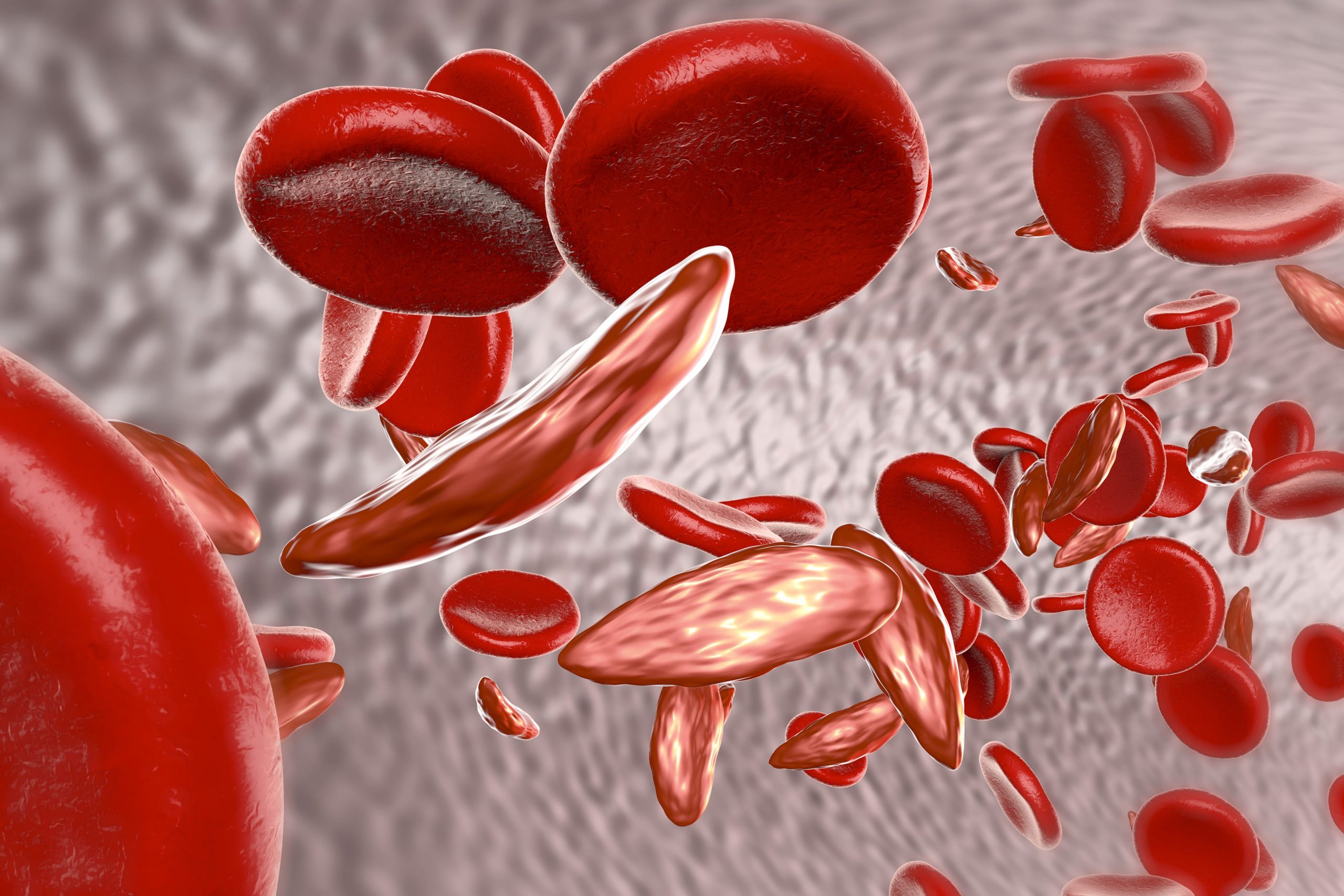 HOW CBD CAN BE BENEFICIAL FOR SICKLE CELL ANEMIA-min