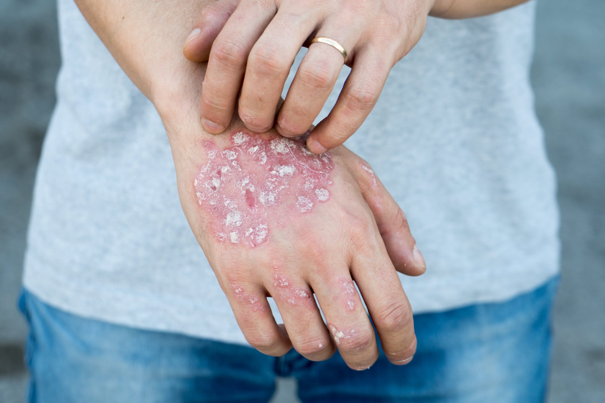 HOW CBD CAN BENEFIT YOU WITH SKIN CONDITIONS LIKE PSORIASIS-min