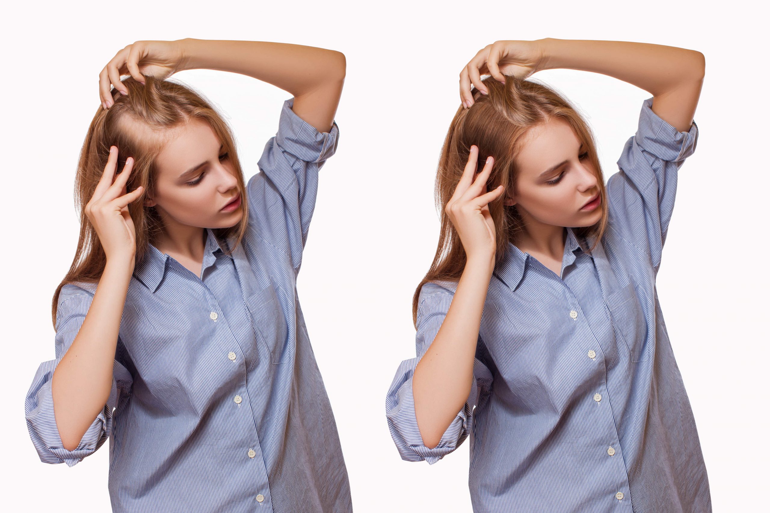 WHAT EFFECTS, CBD OIL CAN MAKE ON OUR HAIR LOSS OR GROWTH-min
