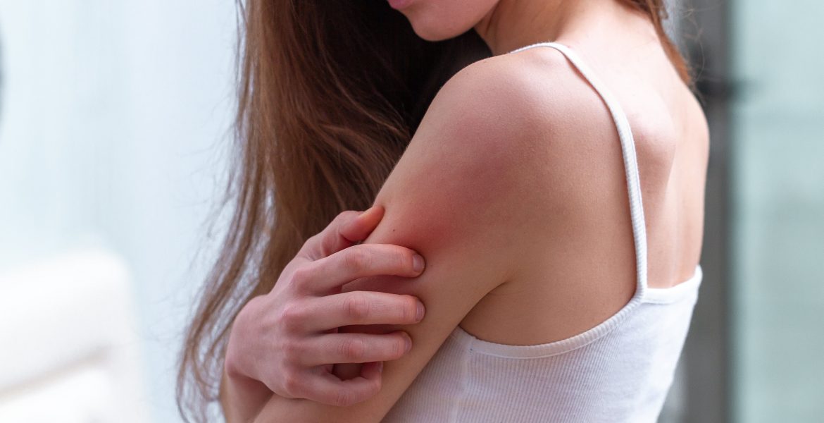 WITH ORGANIC CBD OIL, YOU CAN HEAL THE PAINFUL, ITCHY SKIN-min
