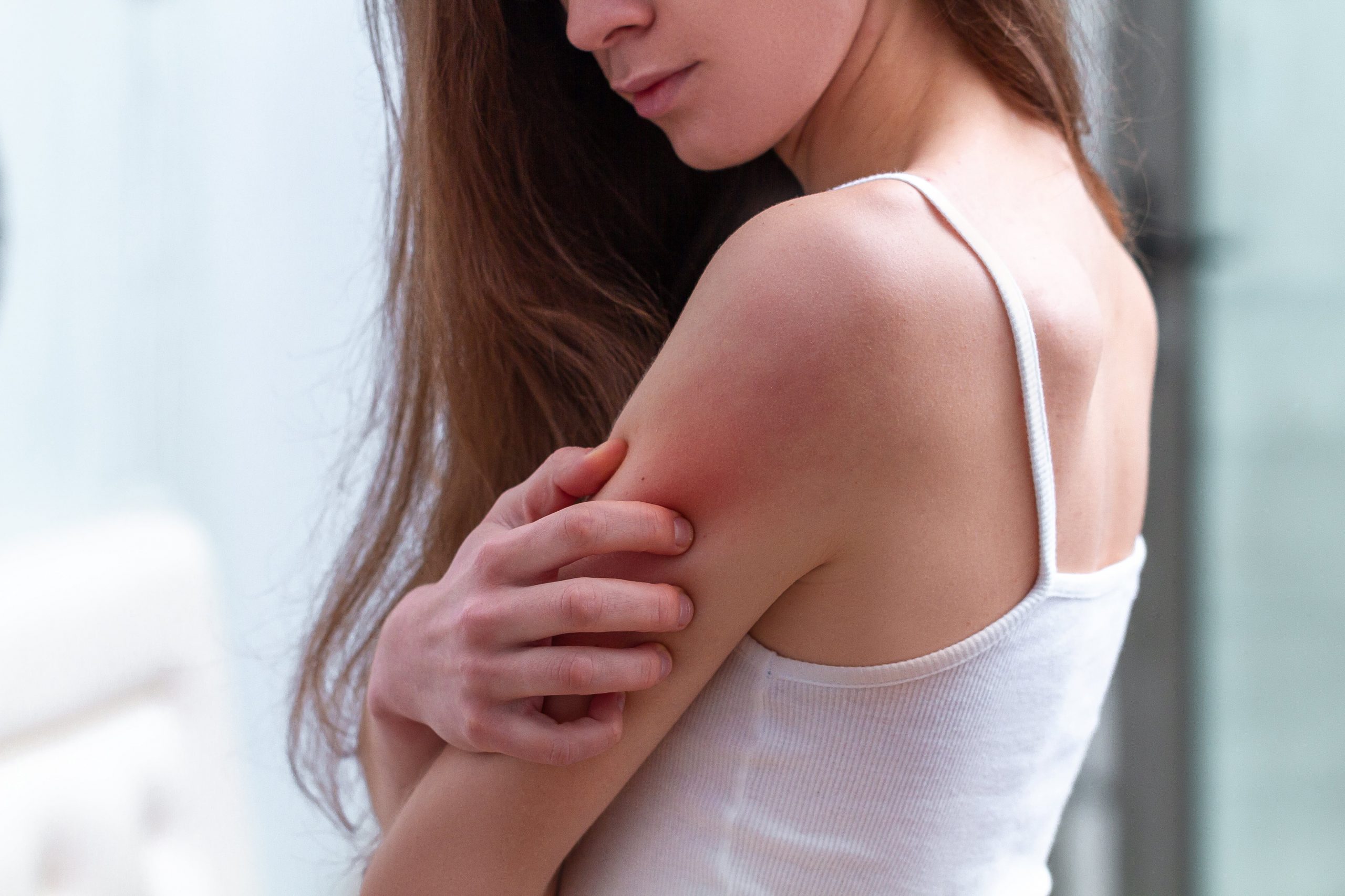 WITH ORGANIC CBD OIL, YOU CAN HEAL THE PAINFUL, ITCHY SKIN-min