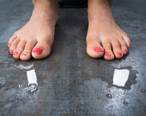 CAUSES AND TREATMENTS FOR SWEATY FEET