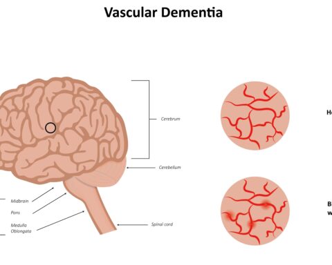 Early Signs of Vascular Dementia