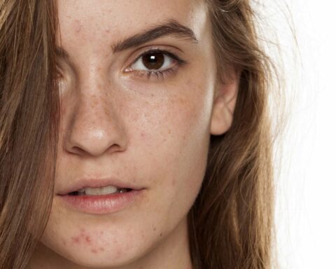 ACNE POSITIVE MOVEMENT GROWING WITH GEN Z & EVEN ADULTS CAN LEARN FROM THEM ON THIS