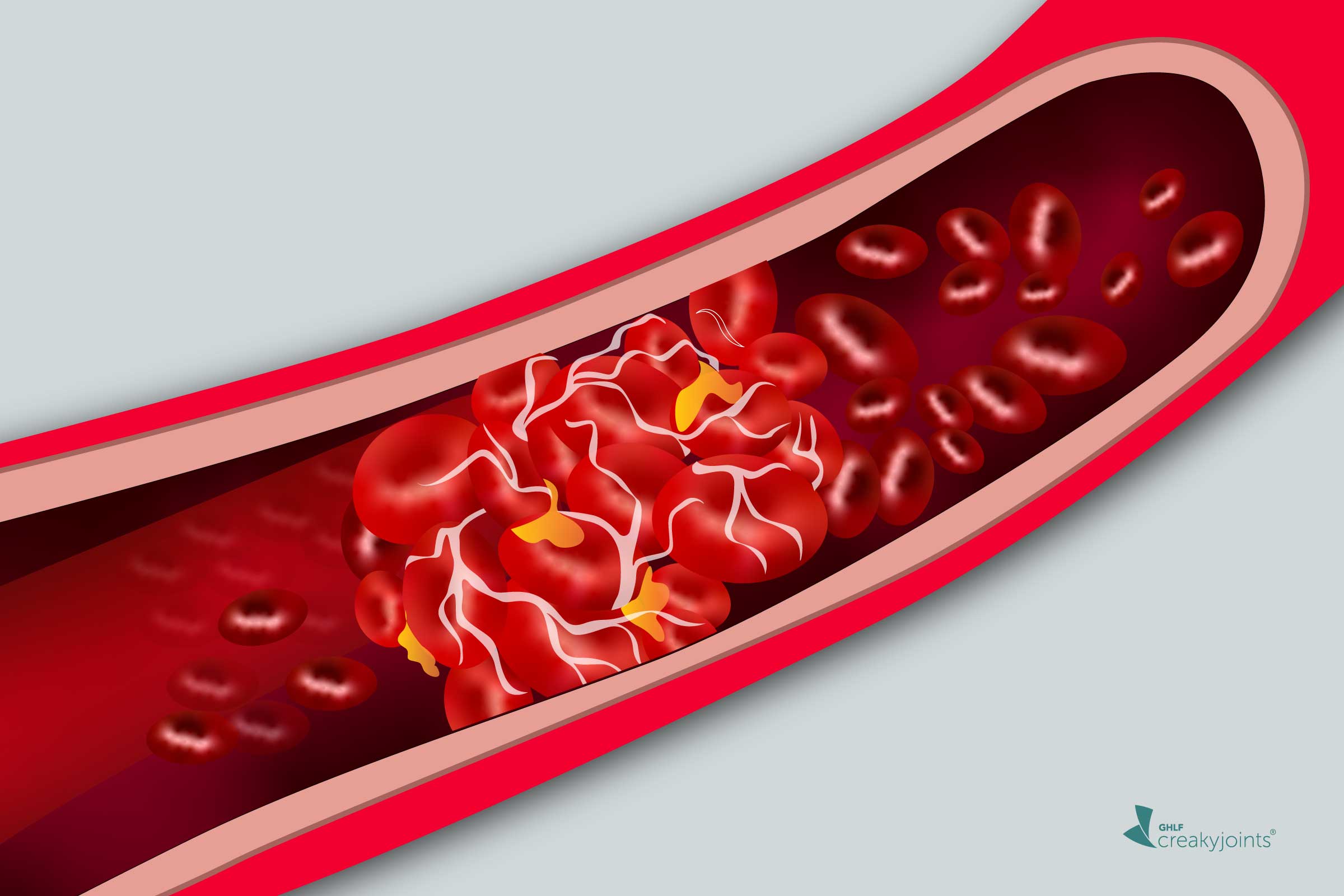 RISK OF BLOOD CLOTS.