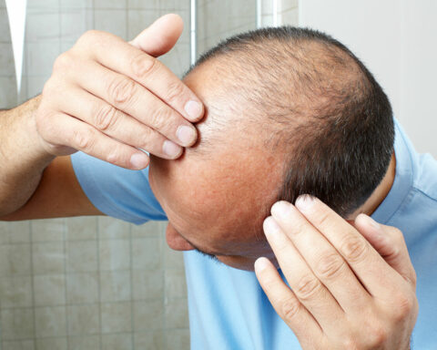 Stress Lead to Hair Loss