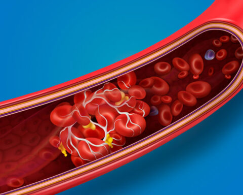 BLOOD CLOTS AND CONDITIONS WHICH CAN INCREASE SOMEONE'S RISK OF THEM