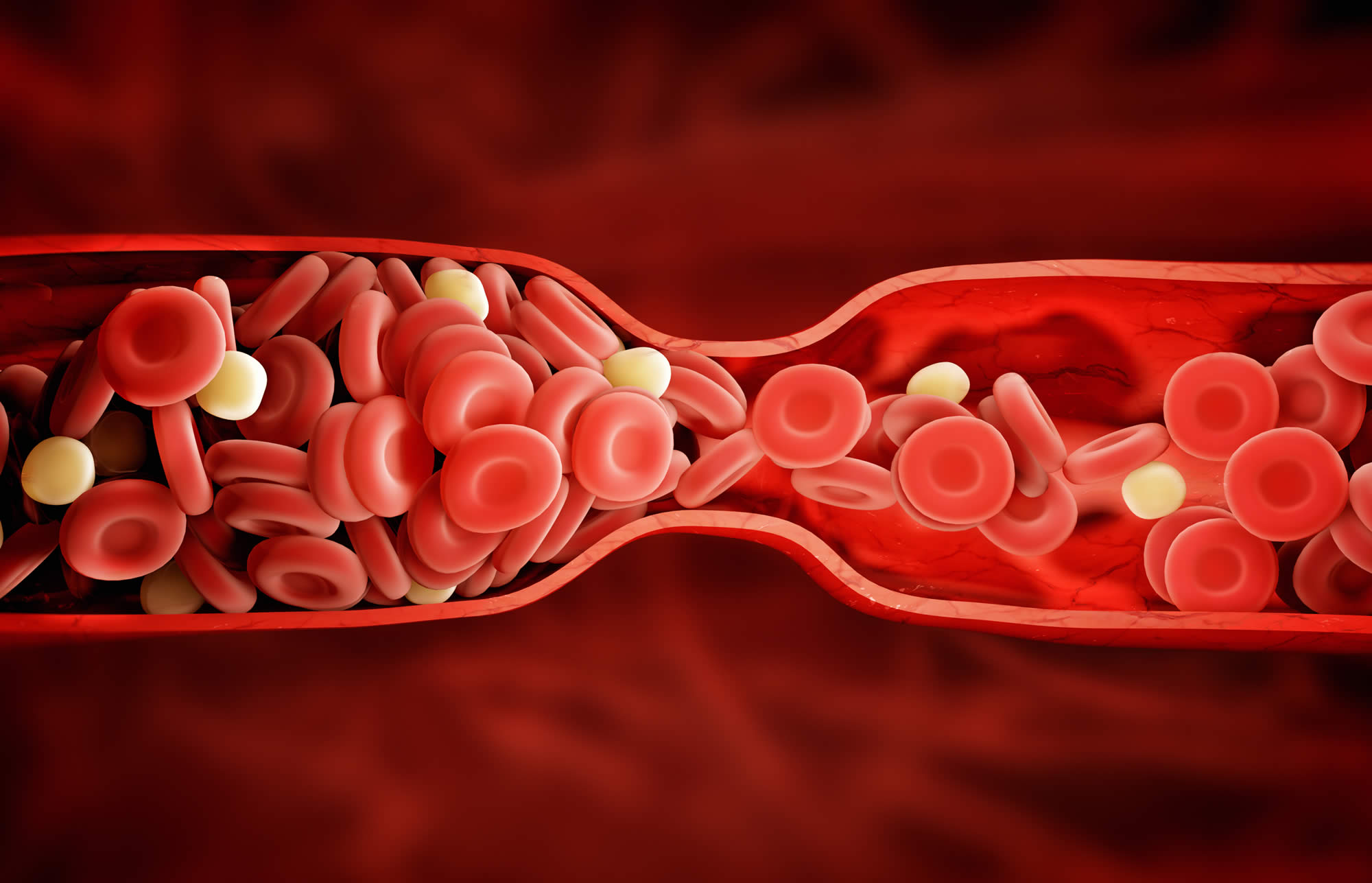 Food or Drinks That Raise the Risk of Blood Clots