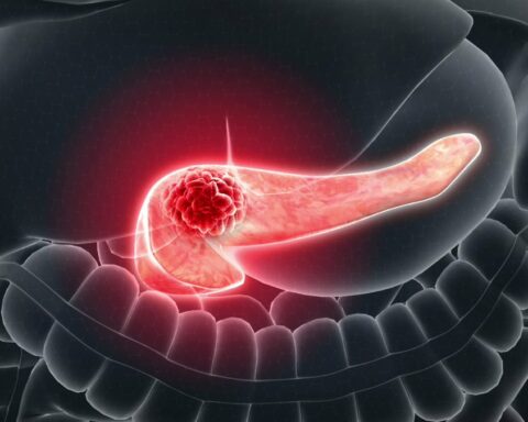 Initial Signs of Pancreatic Cancer