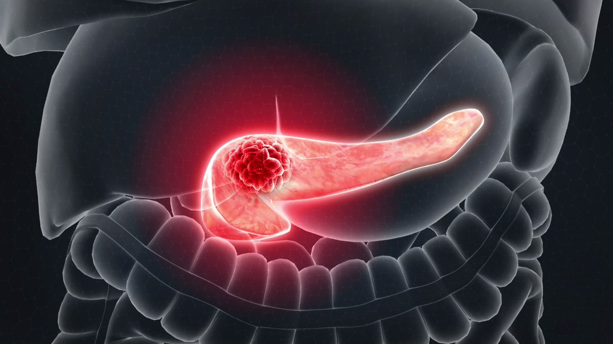 Initial Signs of Pancreatic Cancer