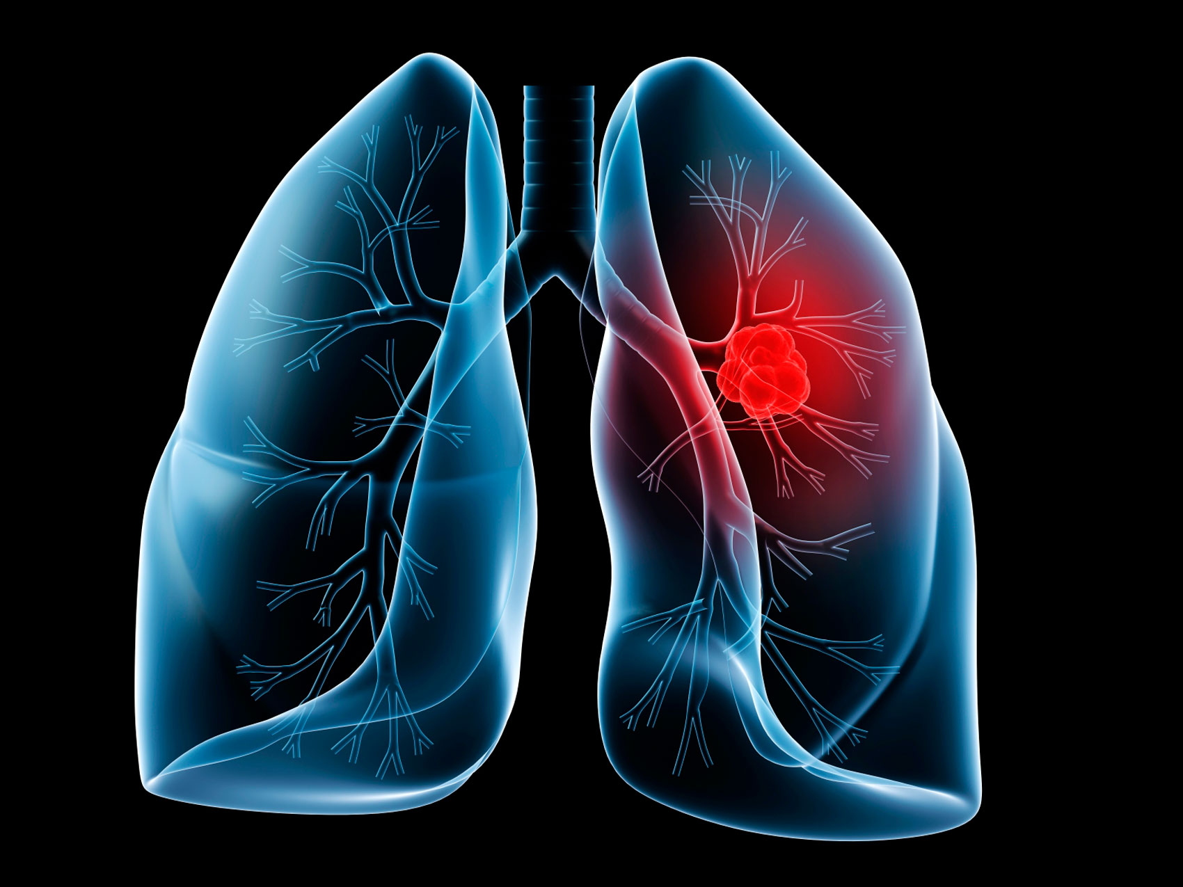 Non-Smoking Related Risk Factors for Lung Cancer
