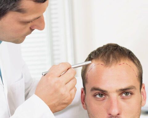 WHAT ARE THE PROS AND CONS OF HAIR TRANSPLANTS?
