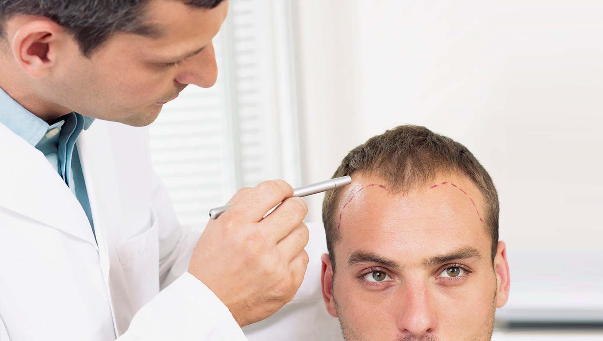 WHAT ARE THE PROS AND CONS OF HAIR TRANSPLANTS?