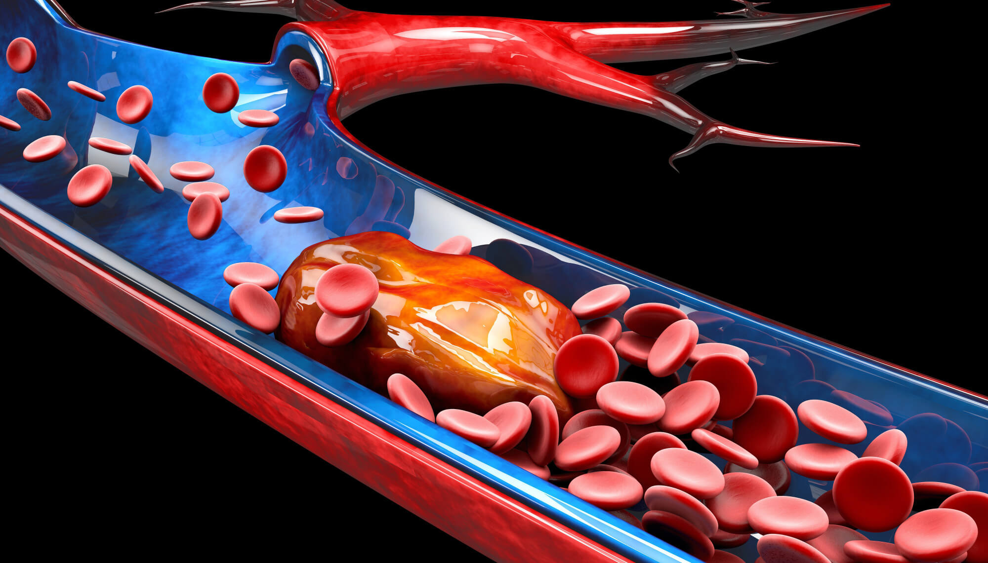 What's The Best Exercise to Prevent Blood Clots?