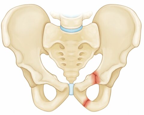 sacral fractures