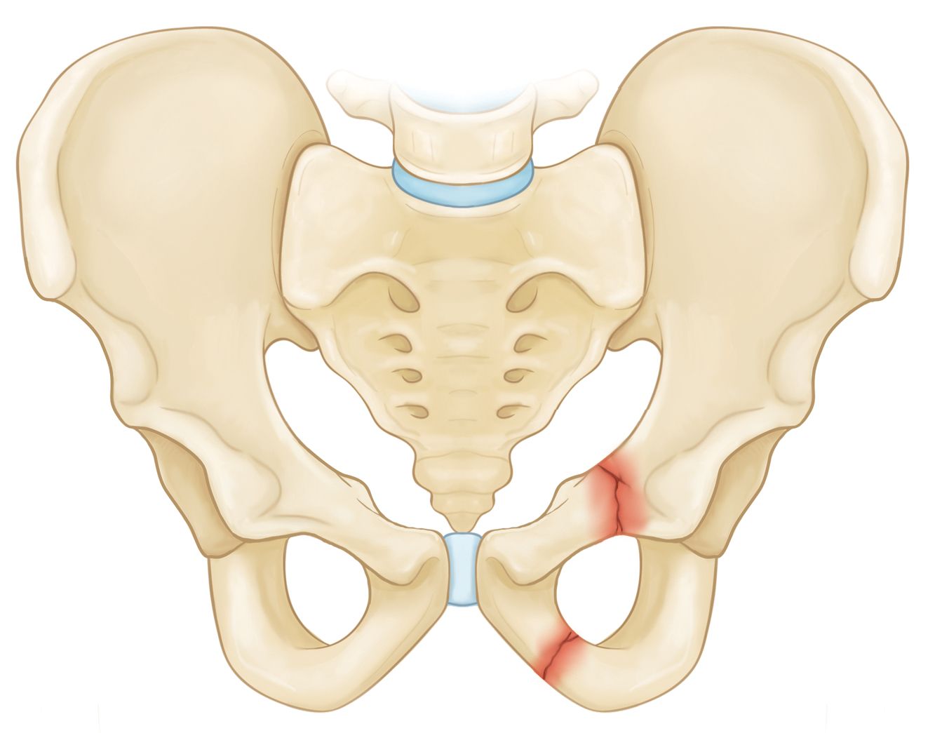 sacral fractures