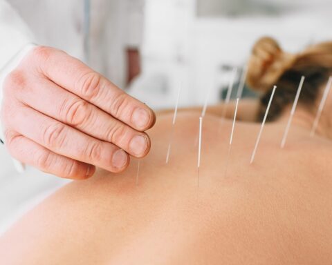 Acupuncture