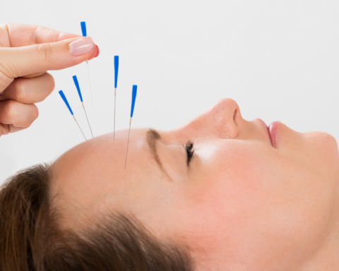 Acupuncture Dream Meaning Interpret Now