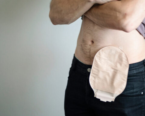 colostomy Bag