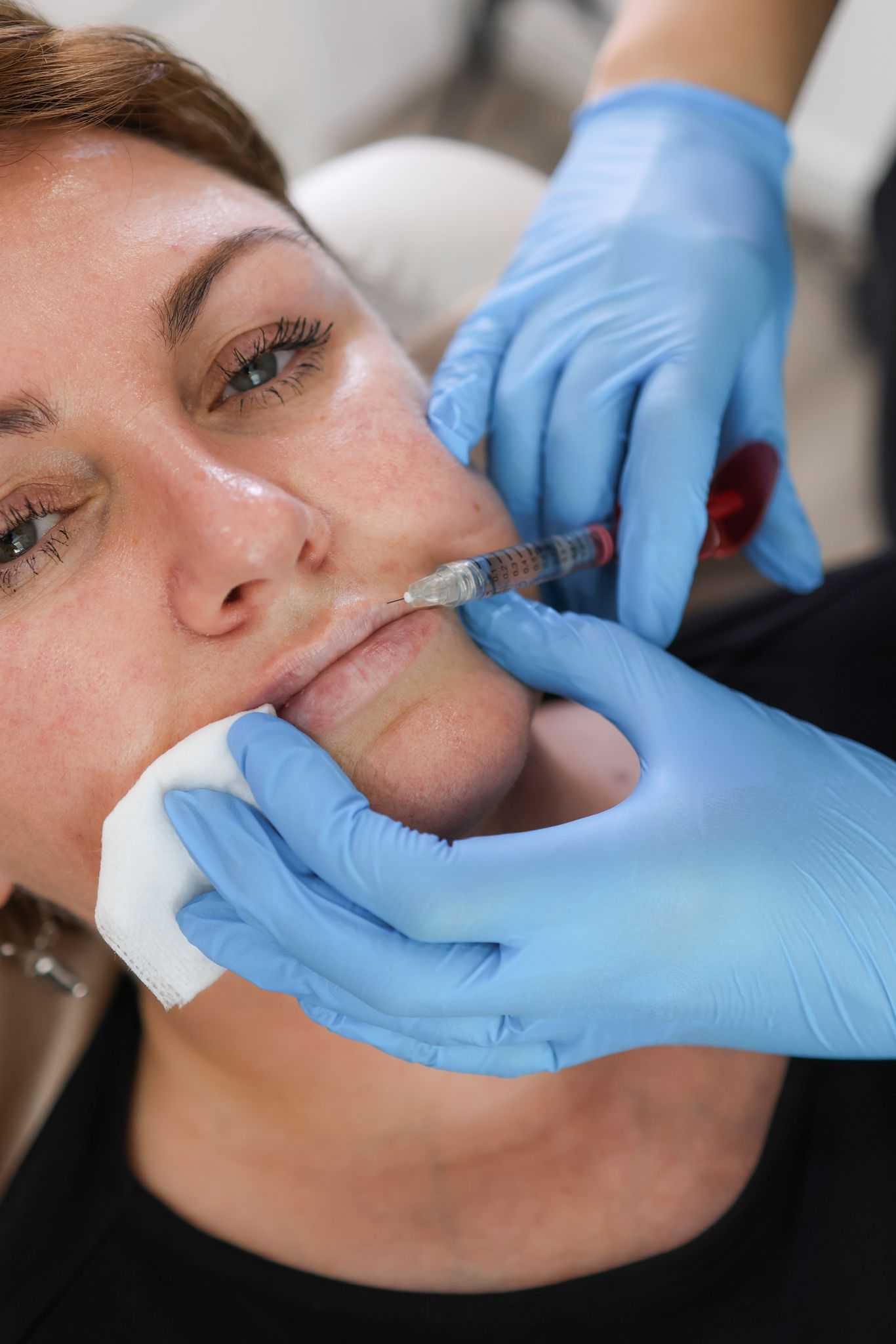 How Long Will It Take to Recover After Lip Filler Treatment?