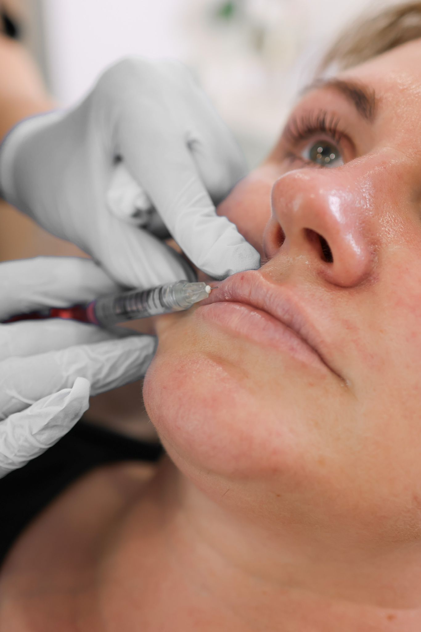 Do Lip Fillers Hurt? A UK Patient's Guide to Comfort