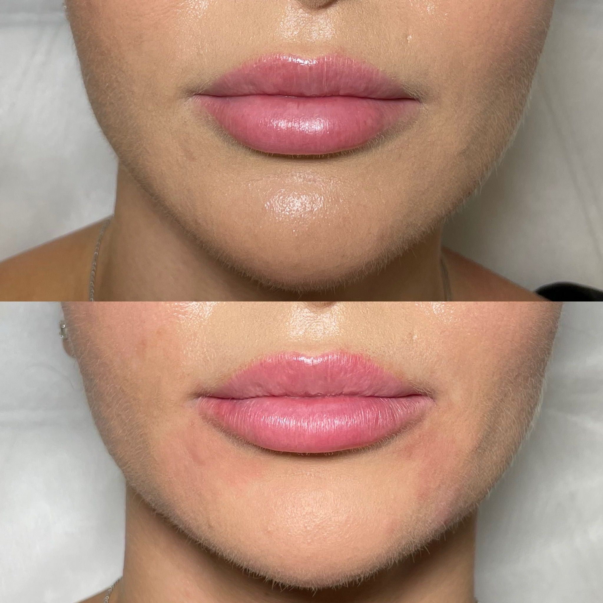 Lip Filler London – Natural Lip Enhancement & Lip Augmentation