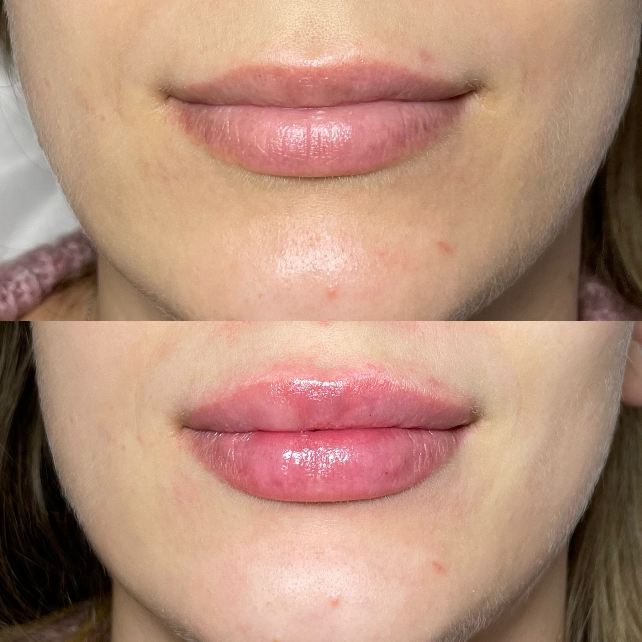Lip Filler London – Natural Lip Enhancement & Lip Augmentation