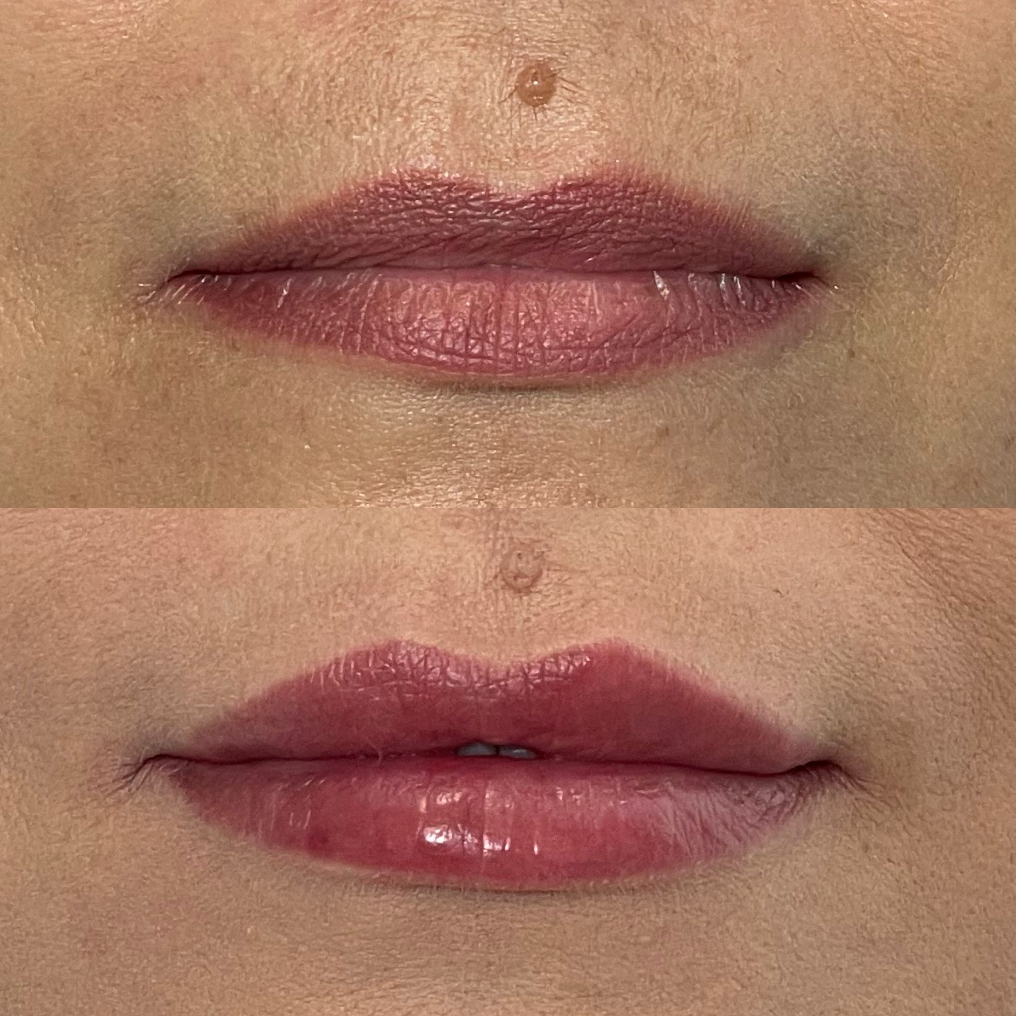 Lip Filler London – Natural Lip Enhancement & Lip Augmentation