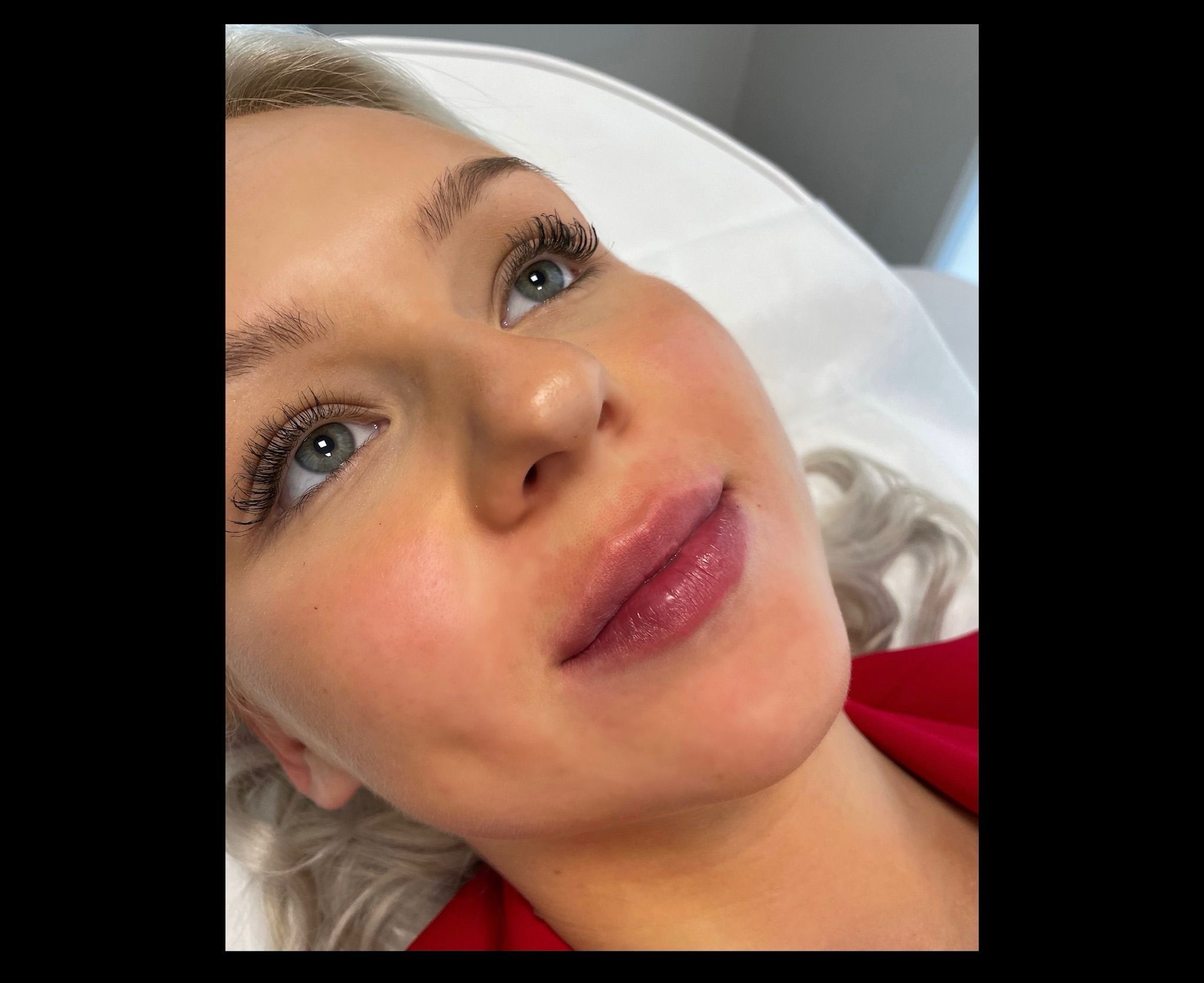 Lip Filler London – Natural Lip Enhancement & Lip Augmentation